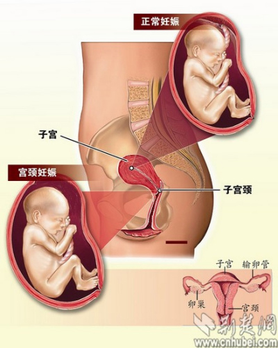 武汉一<em>孕妇</em>宫颈内怀胎7月生下女婴创造奇迹(图